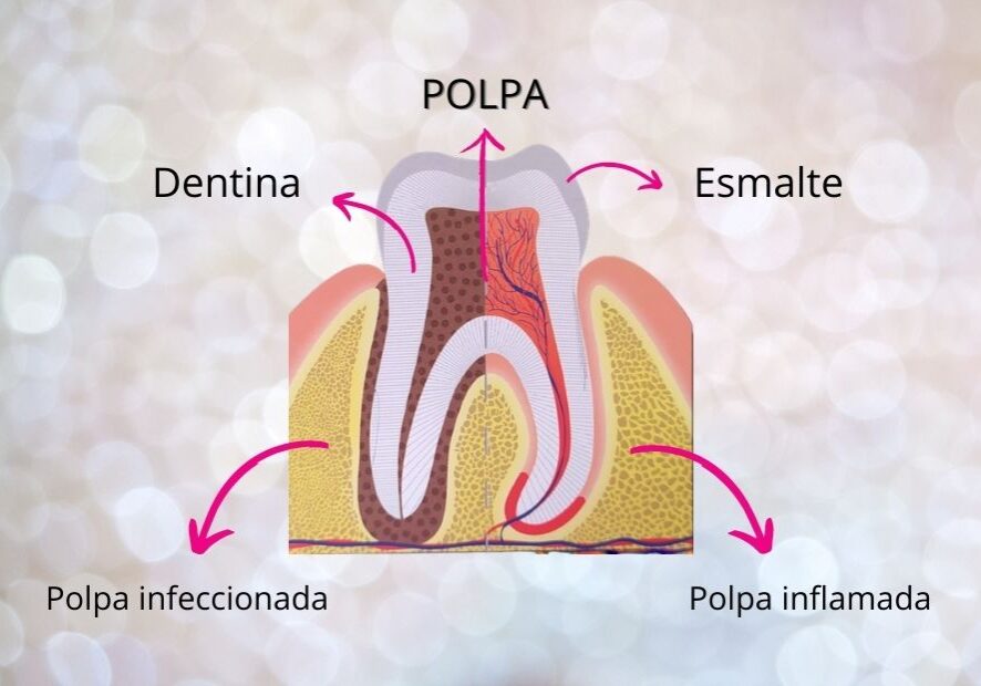 Tratamento de canal